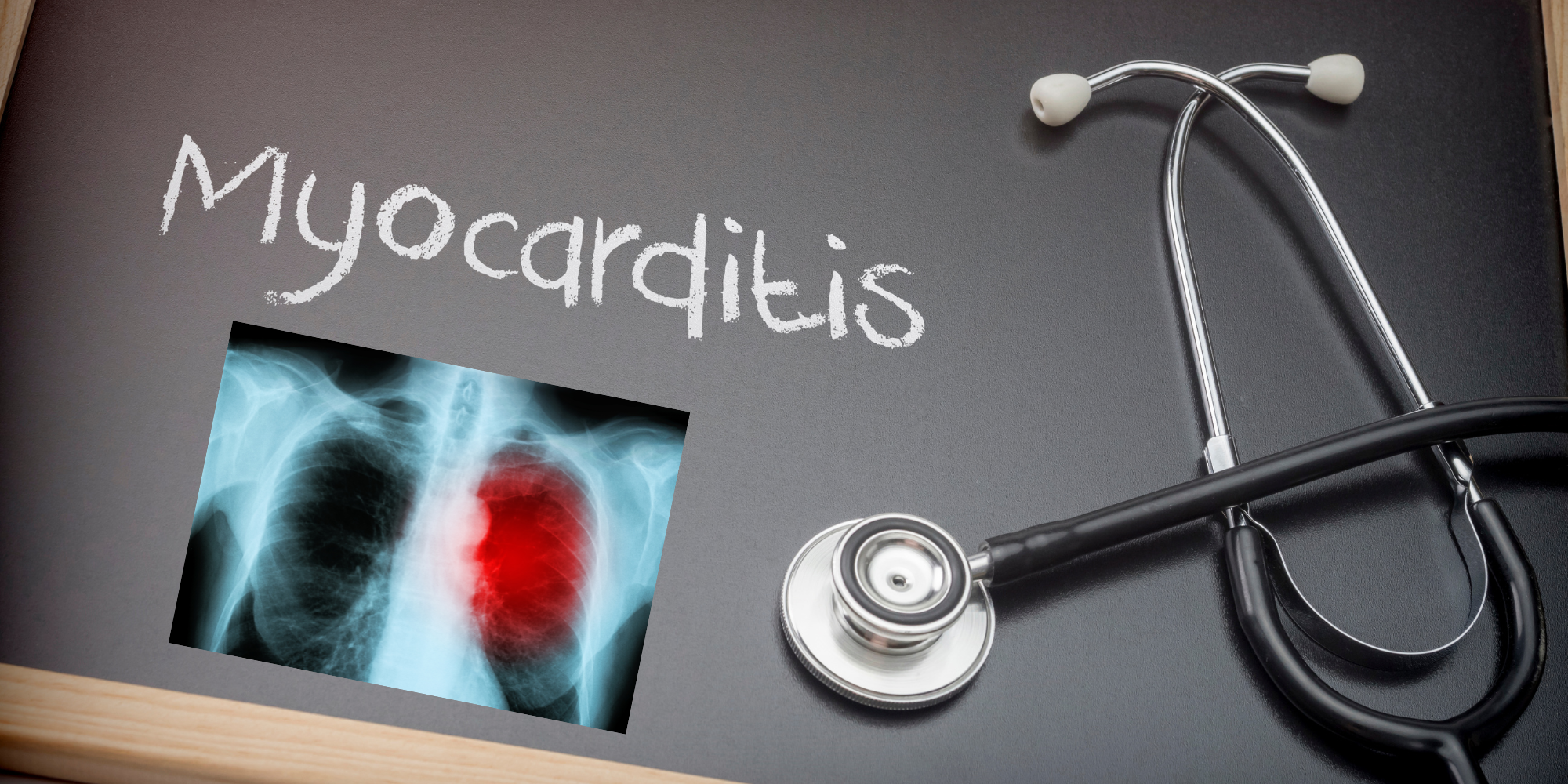 Myocarditis can be caused by some avoidable vices. This includes a bad diet and non-activity
