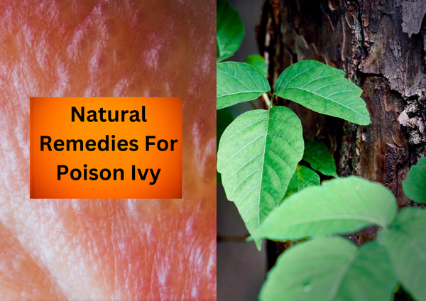 Natural Remedies for Poison Ivy and How Long it is Contagious