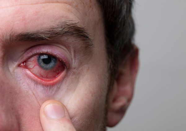 Pink Eye and The Natural Remedies For Pink Eye